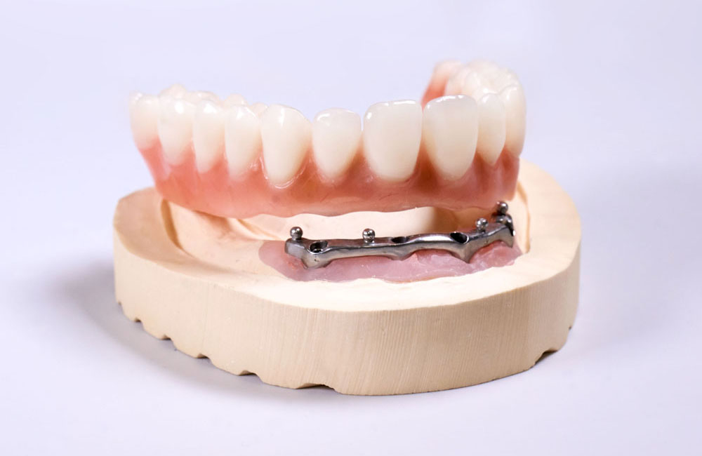 Proteza na implantach – zęby w jeden dzień